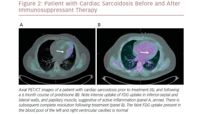 Sarcoidosis and heart failure risks of severe cardiac complications