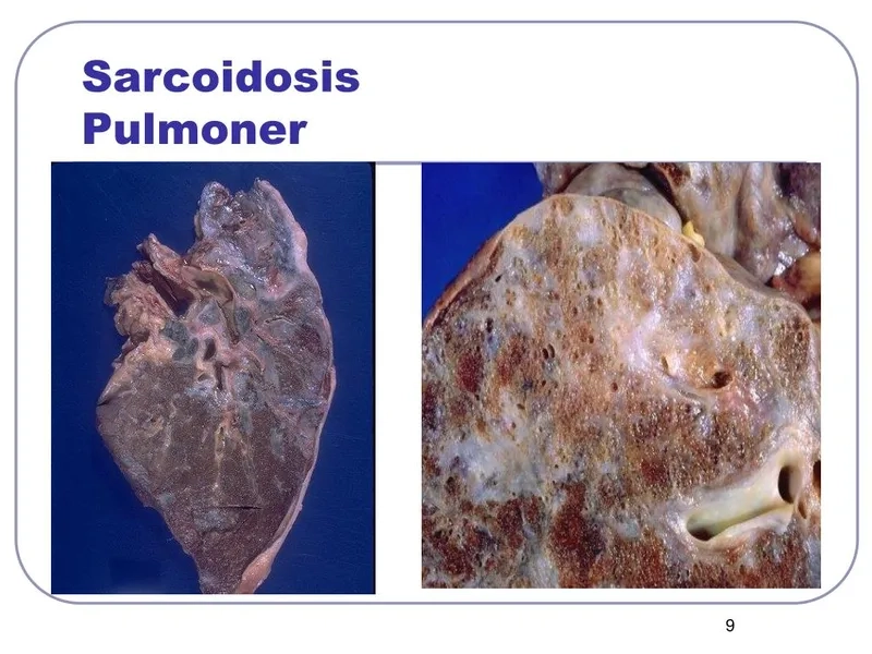 Sarcoidosis prognosis data in clinical research graphic