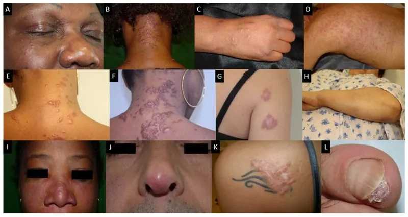Sarcoidosis diagnosis process in laboratory analysis
