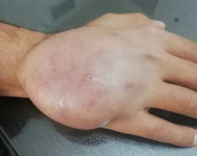 Sarcoma stages from early to advanced