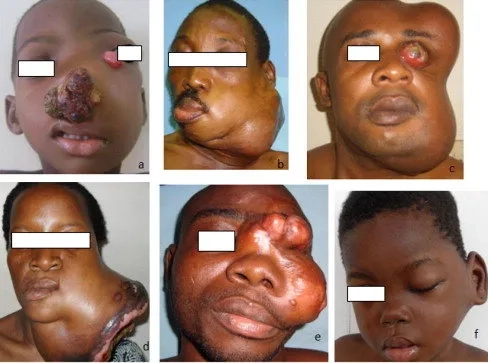 Liposarcoma tumor affecting fat tissue