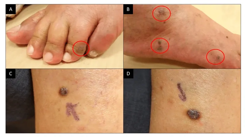 Ewing sarcoma in children and young adults