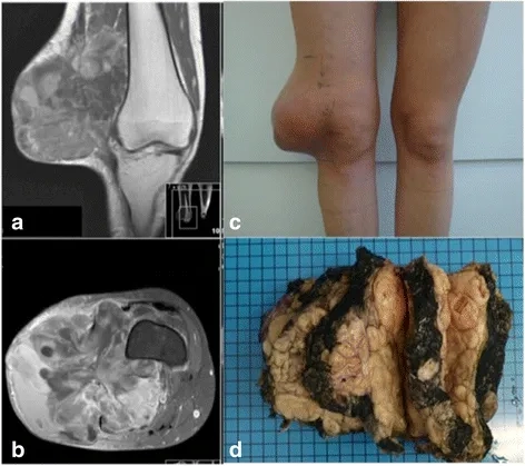 Types of sarcoma affecting body tissues