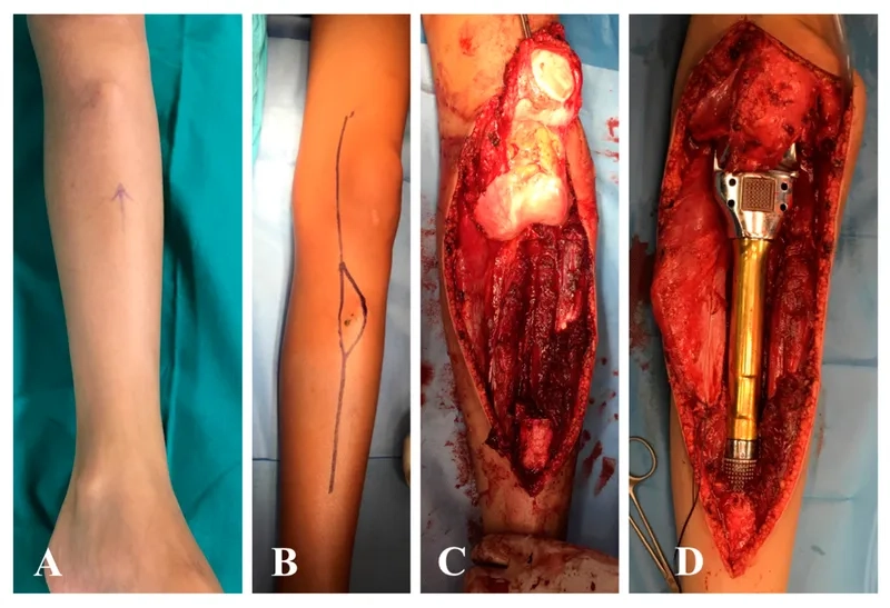 Sarcoma survival rate and patient outlook