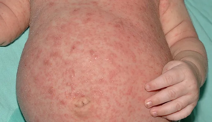A person showing common scabies symptoms on their skin