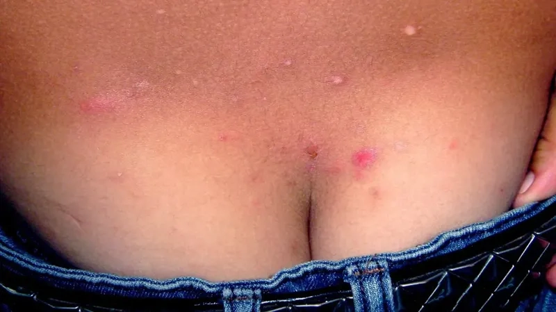 A close-up photograph of a typical scabies rash