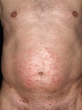 A graphic showing how is scabies contagious person-to-person