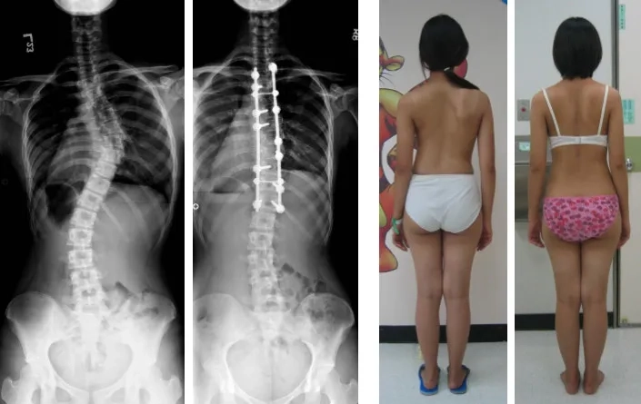An overview of modern scoliosis treatment options
