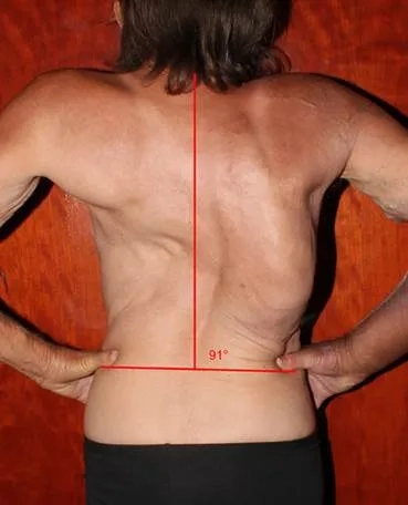 Before and after results of scoliosis surgery