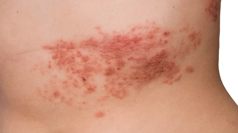 Can you cure shingles in 3 days