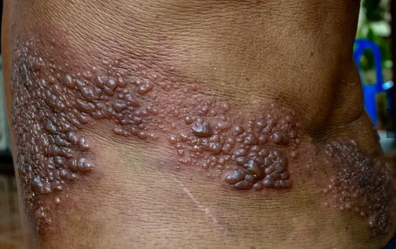 A case of facial shingles outbreak