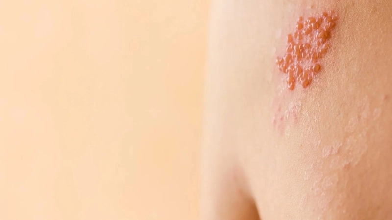 Shingles Herpes Zoster postherpetic pain
