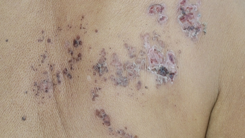 Shingles Herpes Zoster rash on back