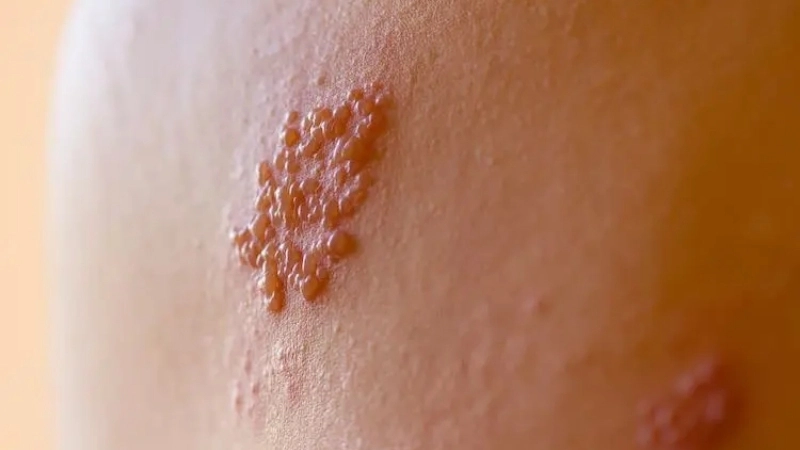 Shingles Herpes Zoster rash pictures