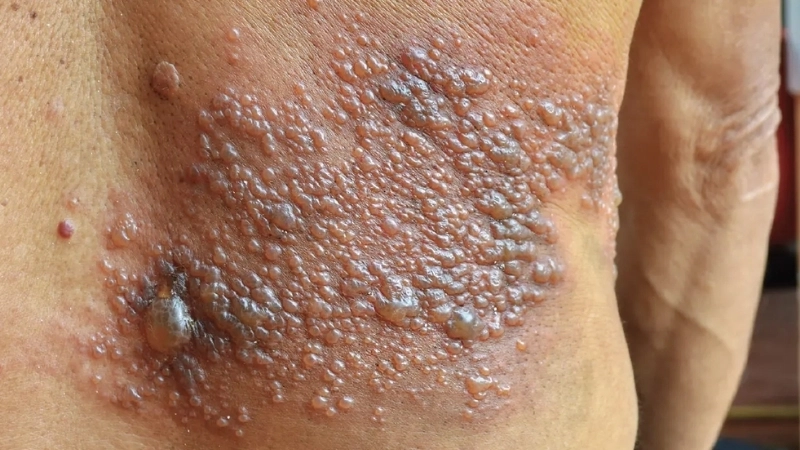 Shingles Herpes Zoster varicella facts