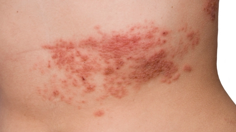Shingles Herpes Zoster treatment tips