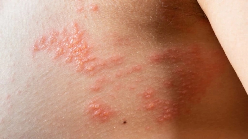 Shingles Herpes Zoster contagious facts