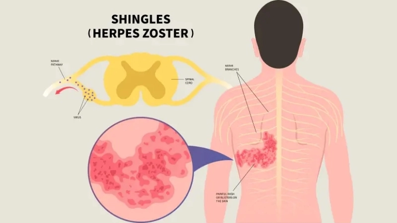 Shingles Herpes Zoster vaccine guide