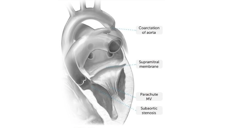 Shone's syndrome a rare congenital heart disorder