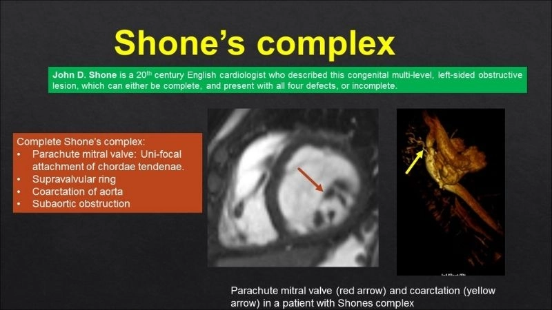 Shone's Complex treatment effective medical approaches