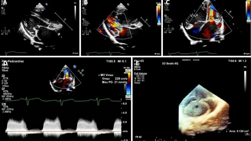 Subaortic stenosis severe narrowing beneath the aortic valve