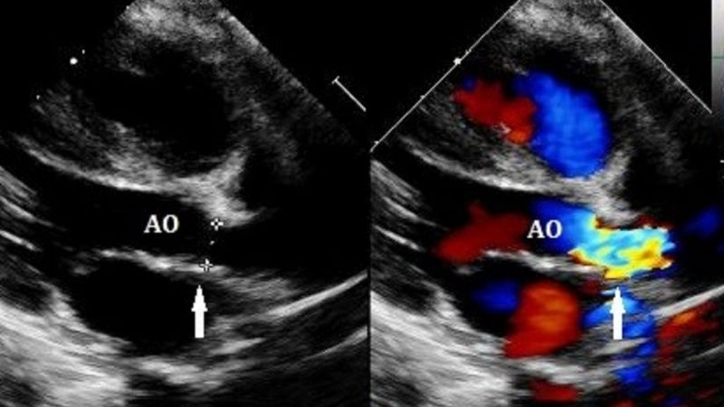 Shone's Complex diagnosis accurate detection of rare disease