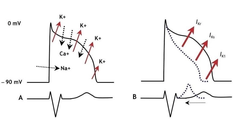 Short QT Syndrome ECG detects abnormal short interval