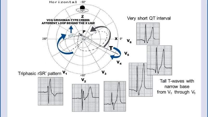 Short QT Syndrome And Sudden Death raise high risk