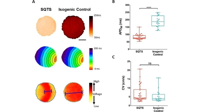 Short QT Syndrome Causes linked to ion channel defect