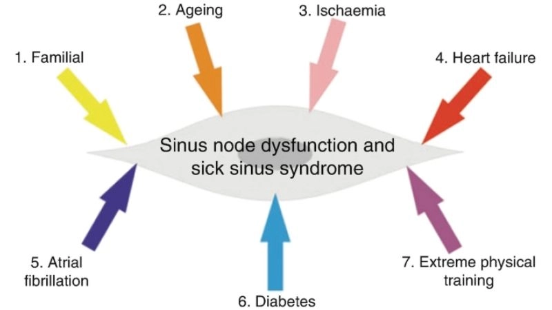 Sick sinus syndrome pacemaker fixes slow or irregular beats