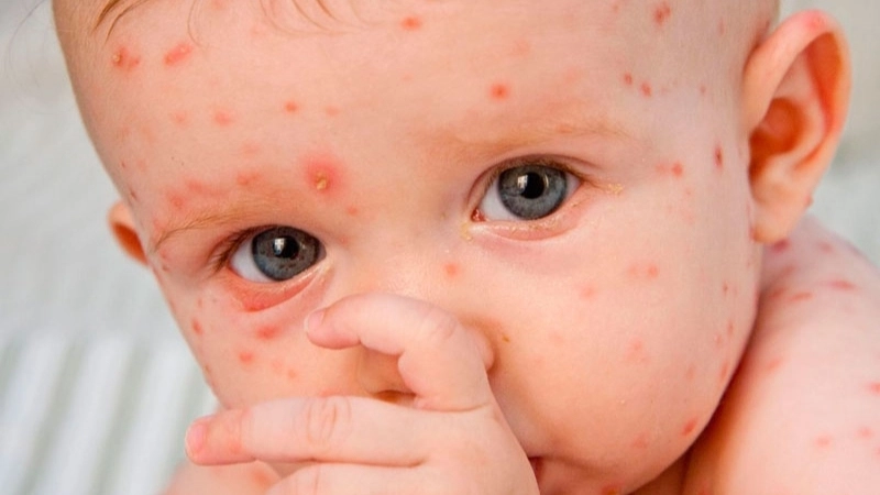 Sindbis Fever with Sindbis virus symptoms