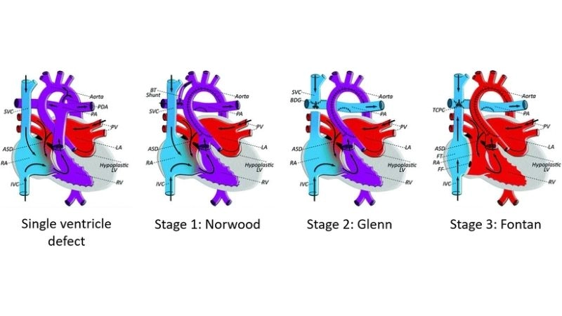 Hypoplastic left heart syndrome as a single ventricle defect