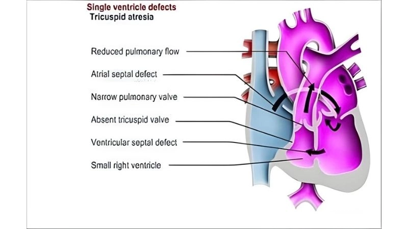 Single ventricle life expectancy survival and outlook