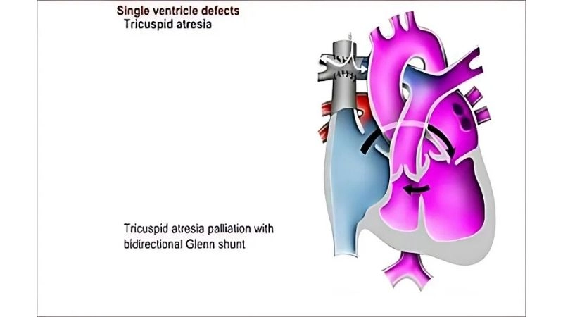 Single ventricle symptoms recognition and early signs