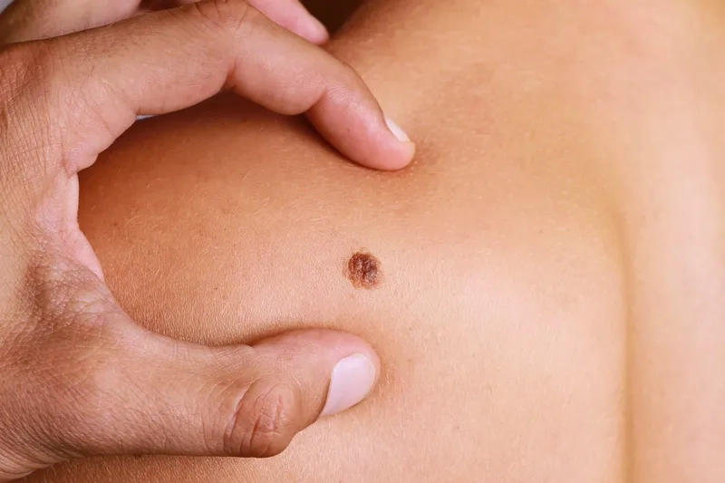 Recognizing the early signs of skin cancer on the skin