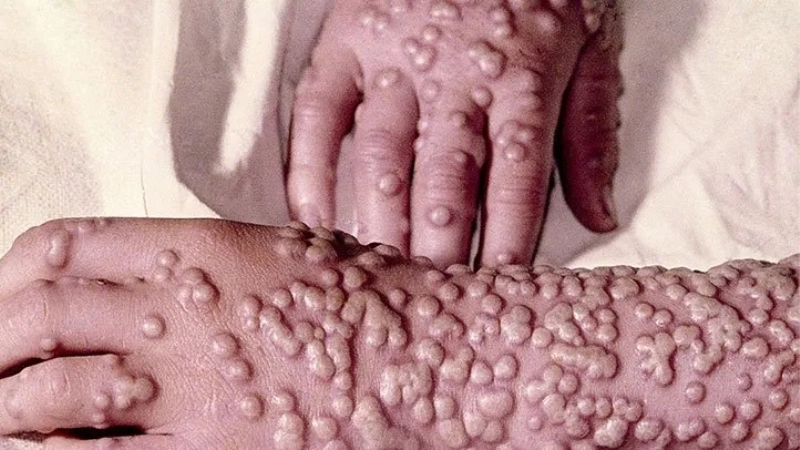 Know smallpox symptoms linked to smallpox