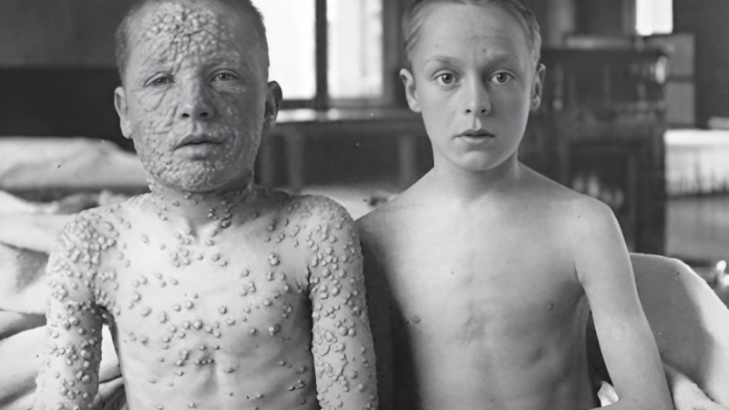 Exploring smallpox history of smallpox era