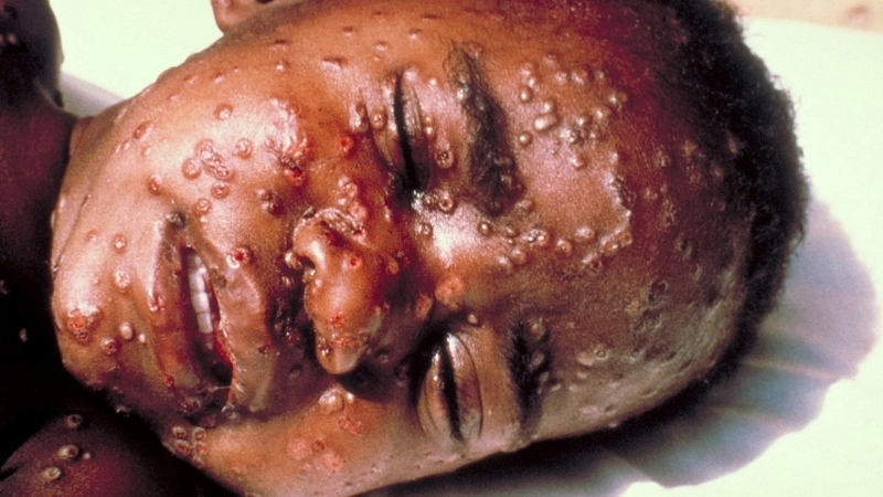 Understanding smallpox causes behind smallpox