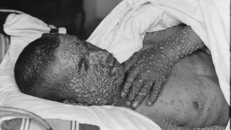 Tips for smallpox prevention from smallpox