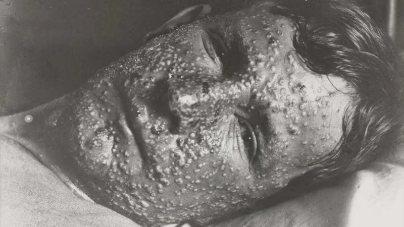 Journey to smallpox eradication of smallpox