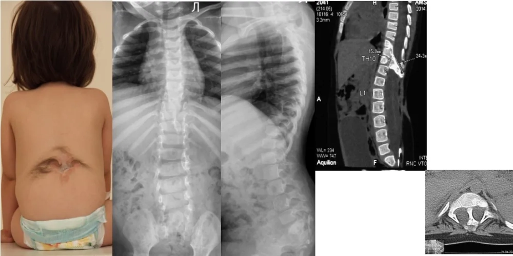 Prenatal care to help prevent spina bifida