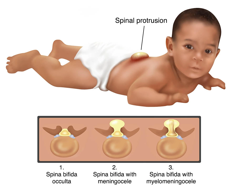 A diagram of the myelomeningocele form