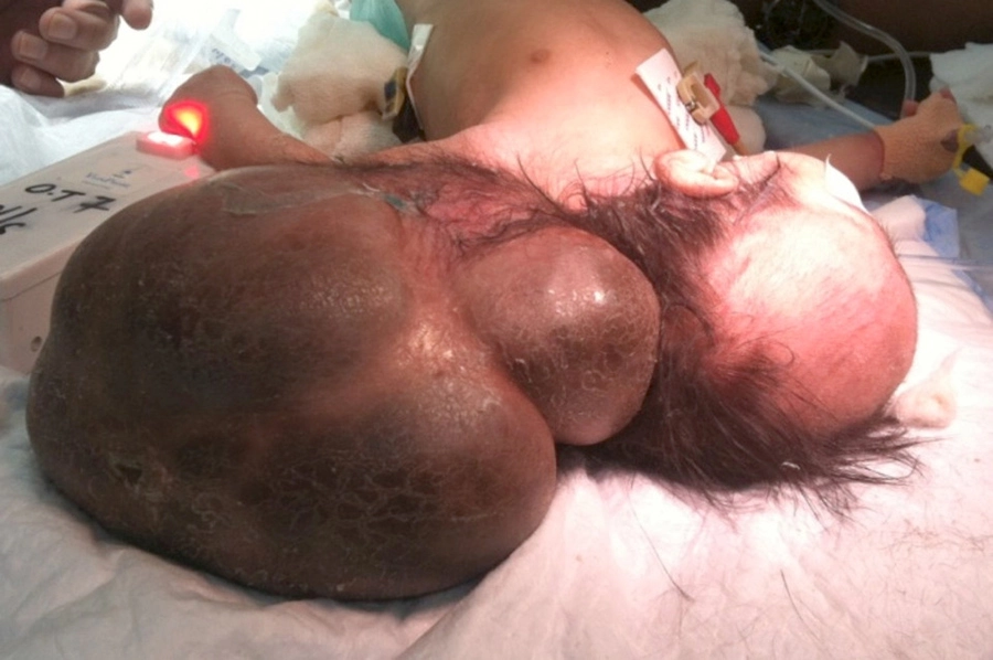 A baby who has had spina bifida surgery