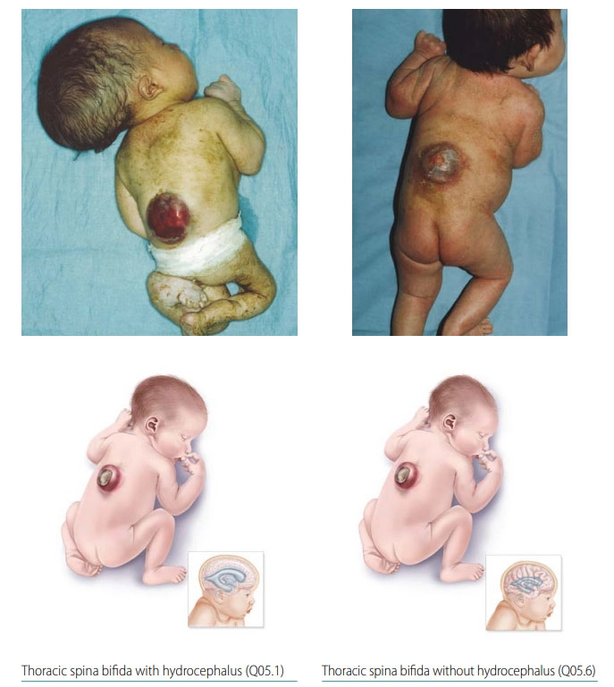 The meningocele type of spina bifida