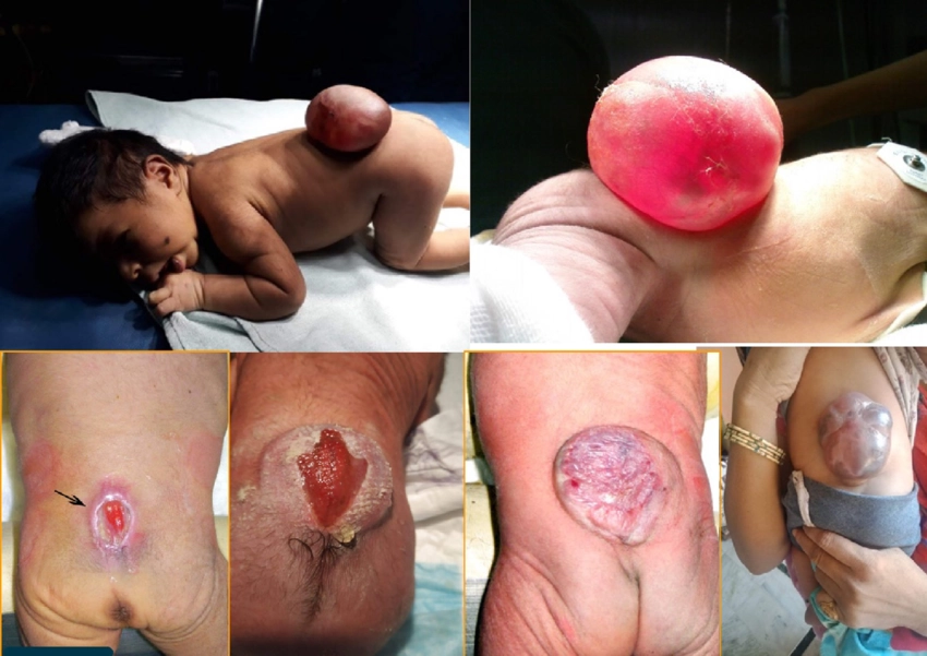 A child living a full life with spina bifida