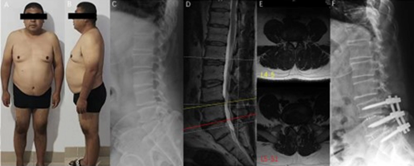 Understanding the causes of lumbar spinal stenosis