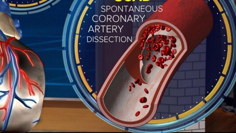 Rare but deadly SCAD heart attack cases
