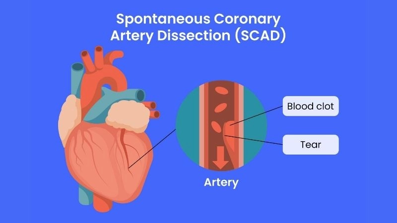 Early warning signs and symptoms of SCAD