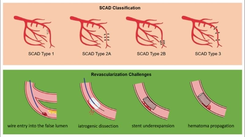 Modern lifesaving options for SCAD treatment