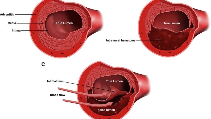 Link between SCAD and fibromuscular dysplasia FMD